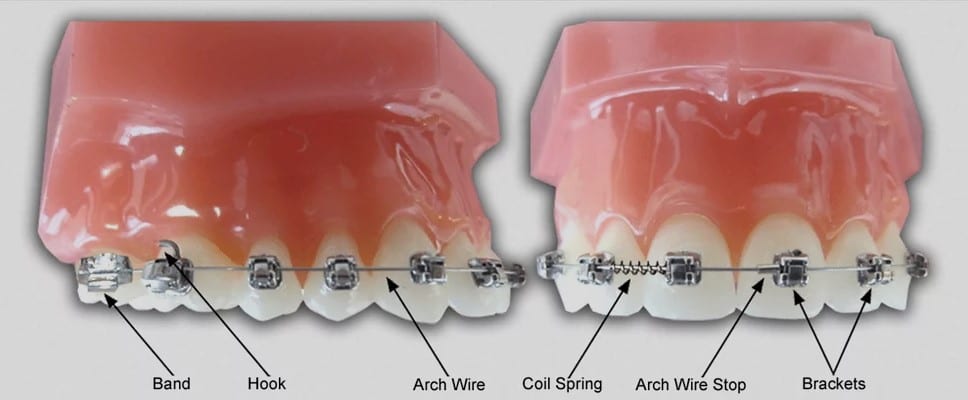 Parts of braces